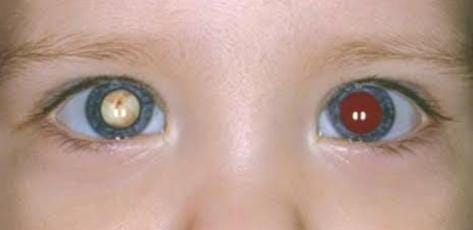 Oftalmologista alerta sobre cuidados com a saúde ocular das crianças e risco de retinoblastoma