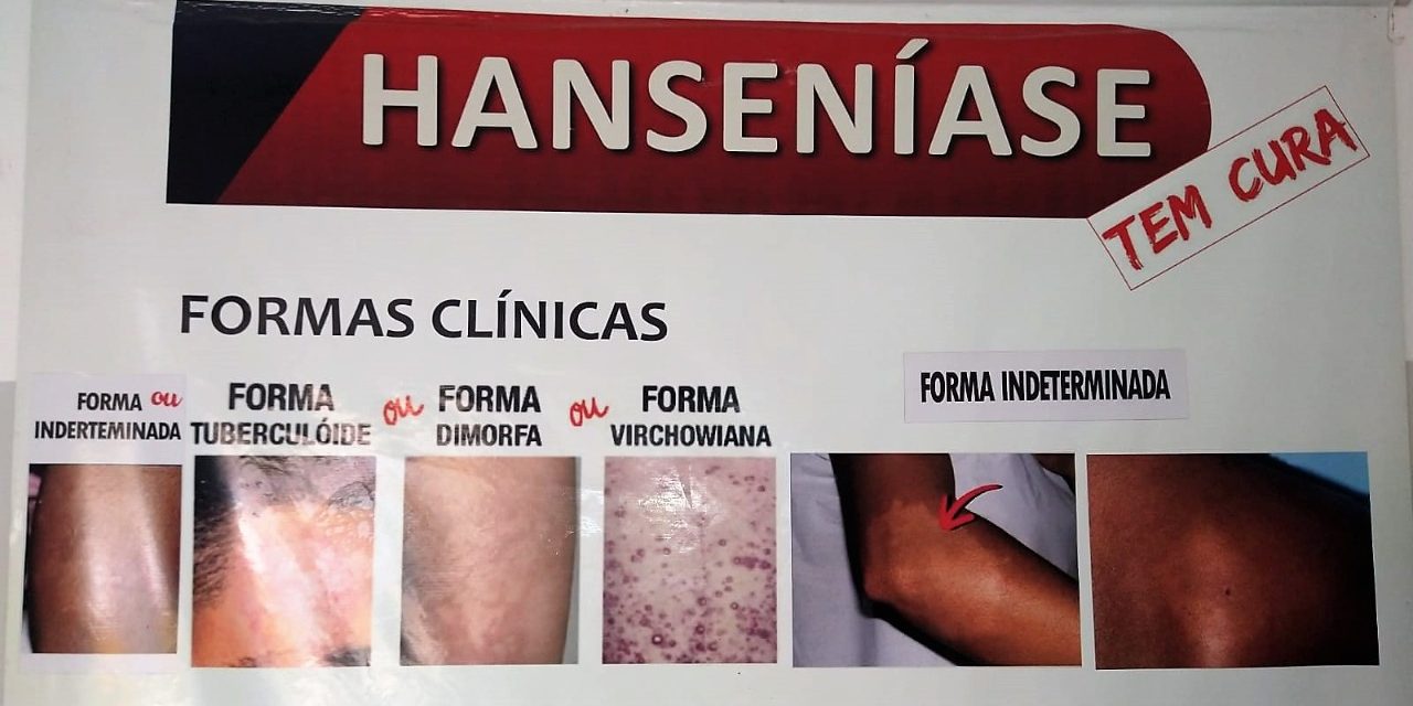 Secretaria Municipal de Saúde diagnostica quatro casos de Hanseníase em Itabuna
