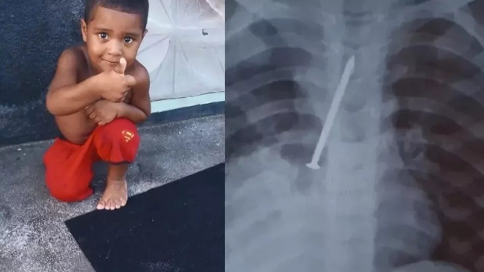 Menino morre após passar 1 ano com prego no pulmão na Bahia; família acusa hospital de negligência