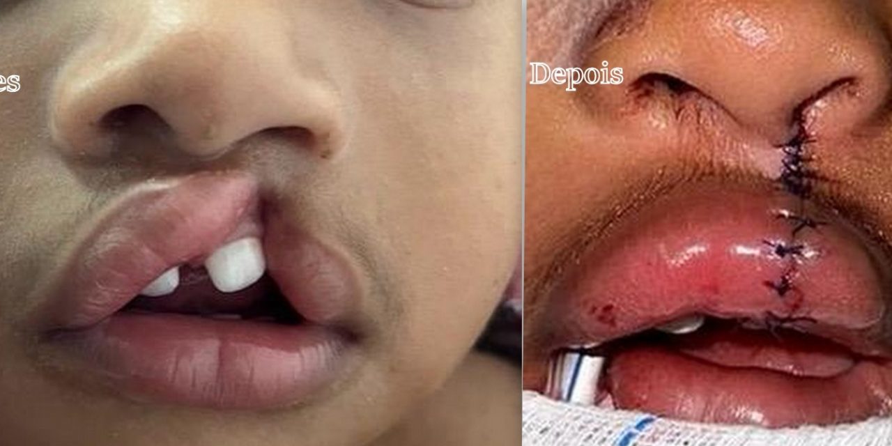 Ilhéus: criança de 2 anos passa por correção de lábio fissurado no Hospital Materno-Infantil