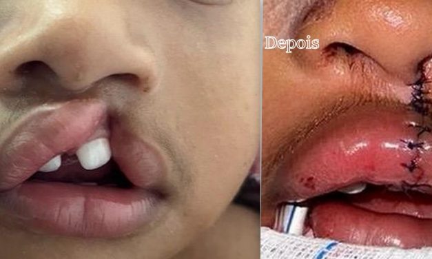 Ilhéus: criança de 2 anos passa por correção de lábio fissurado no Hospital Materno-Infantil